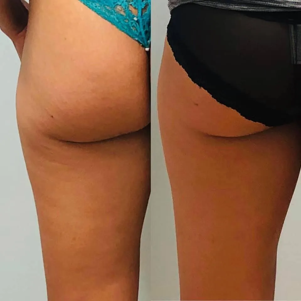 Before and after